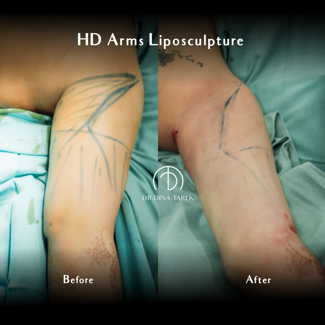 HD lipo arms