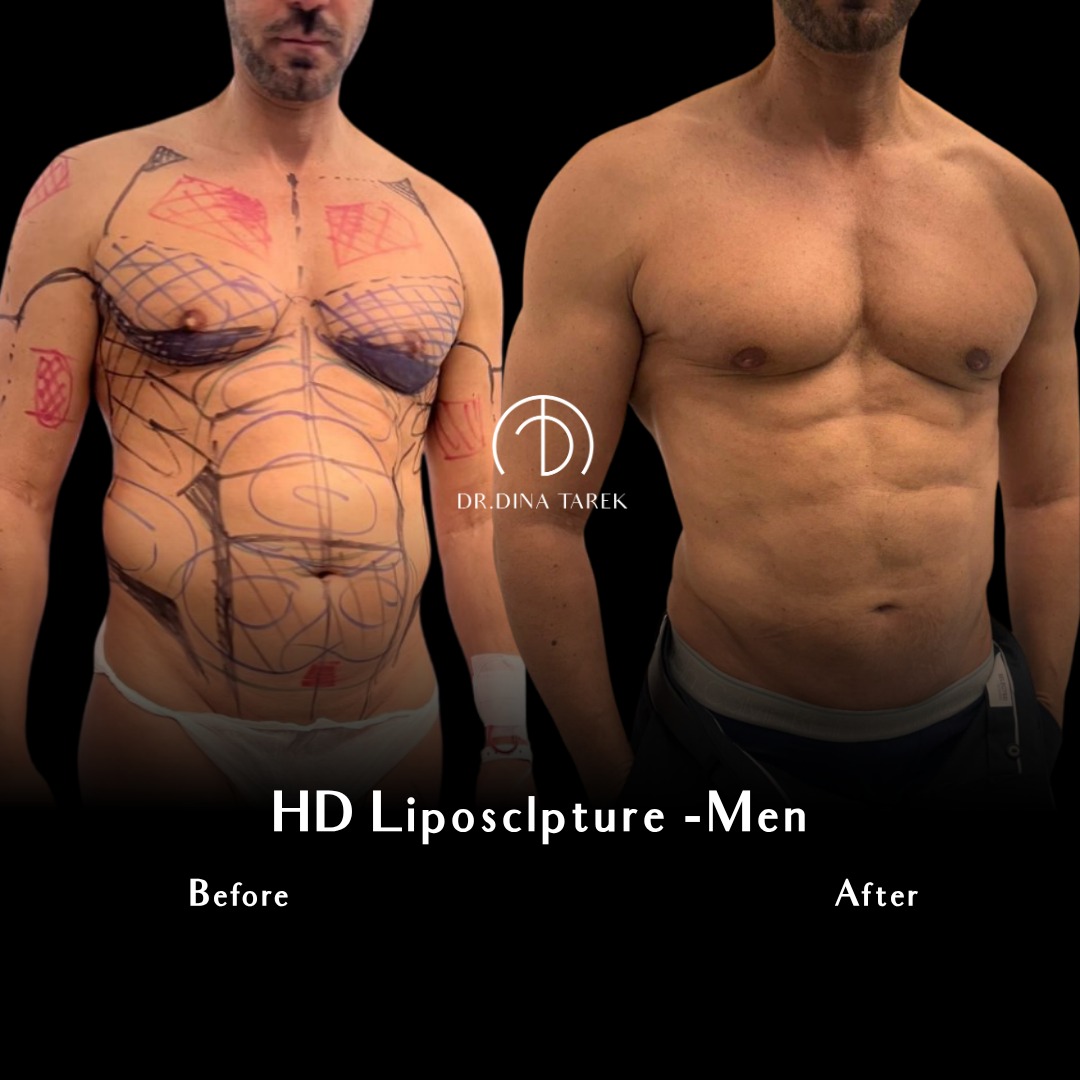 HD lipo men