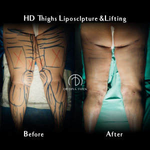 HD lipo thighs2