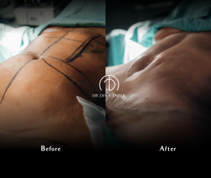 Tummy tuck mommy makeover total body lift 1