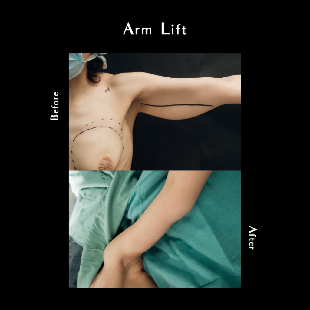 arm lift