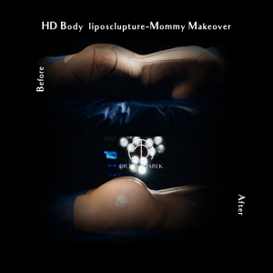 bbl HD lipo Mommy makeover 1