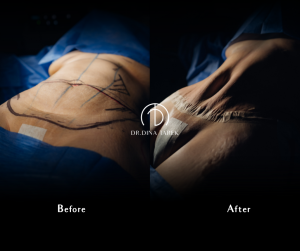 moomy makeover Tummy tuck 1 4